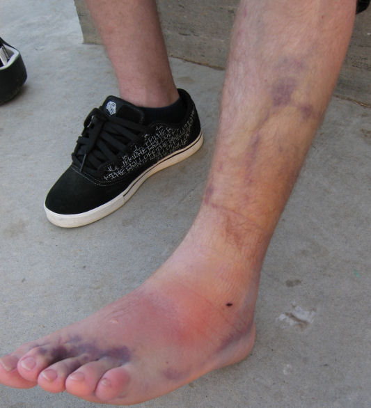 Close-up of Michael's leg and ankle